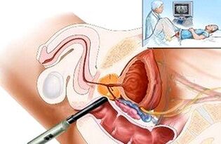 formas de diagnosticar a prostatite