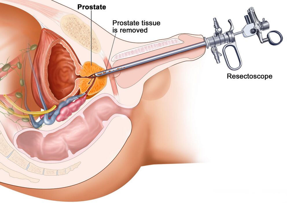 Recollida de tecido prostático para o diagnóstico preciso da prostatite